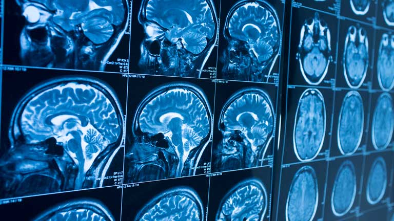 X-ray views of a brain
